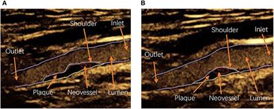 Studying the Factors of Human Carotid Atherosclerotic Plaque Rupture, by Calculating Stress/Strain in the Plaque, Based on CEUS Images: A Numerical Study